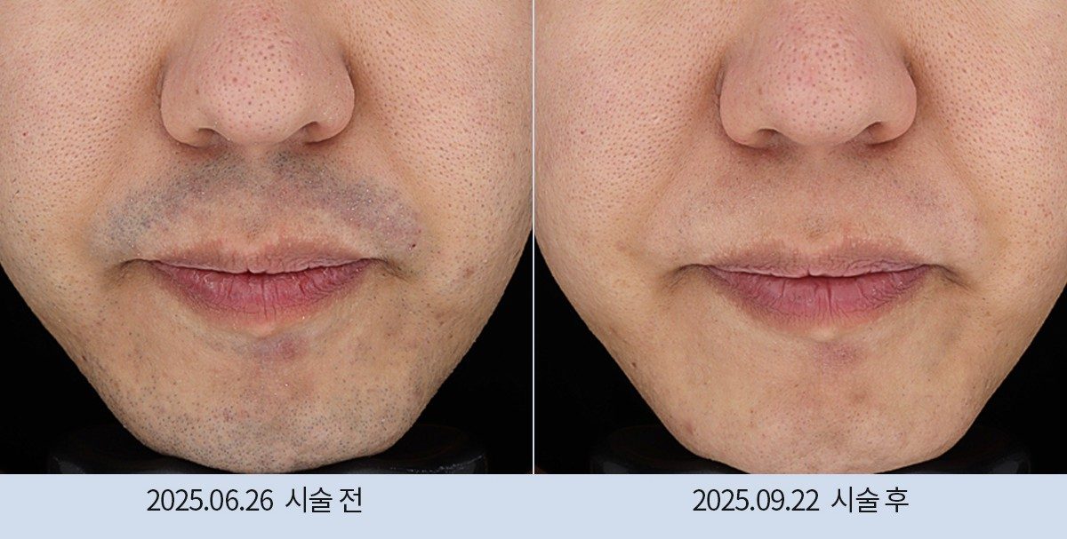 스노우의원 다산점 레이저 제모 전후